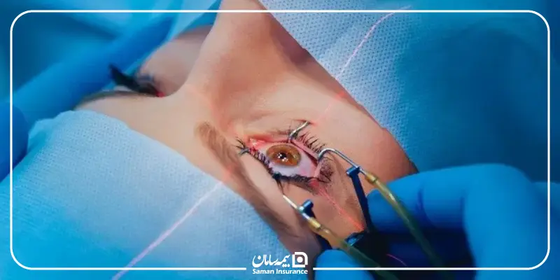 بیمه تکمیلی لیزیک چیست؟