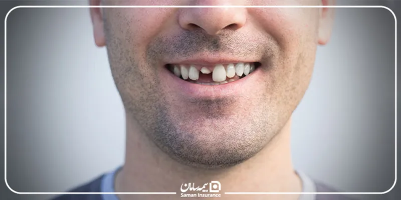 دیه از بین رفتن دندانهای جلو در سال ۱۴۰۵