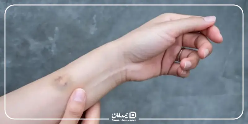 انواع دیه کبودی و کوفتگی چگونه محاسبه میشود؟