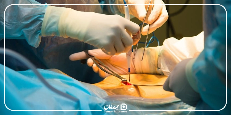 هزینه جراحی لاپاراسکوپی در 1405 چقدر است؟