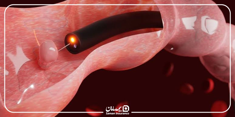 هزینه کولونوسکوپی با بیمه تأمین اجتماعی