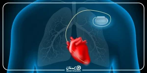 هزینه باتری قلب با بیمه
