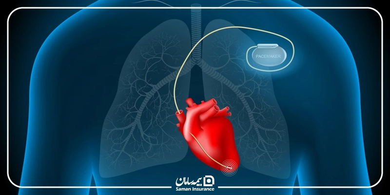 هزینه باتری قلب با بیمه