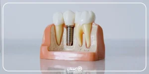 هزینه ایمپلنت با بیمه
